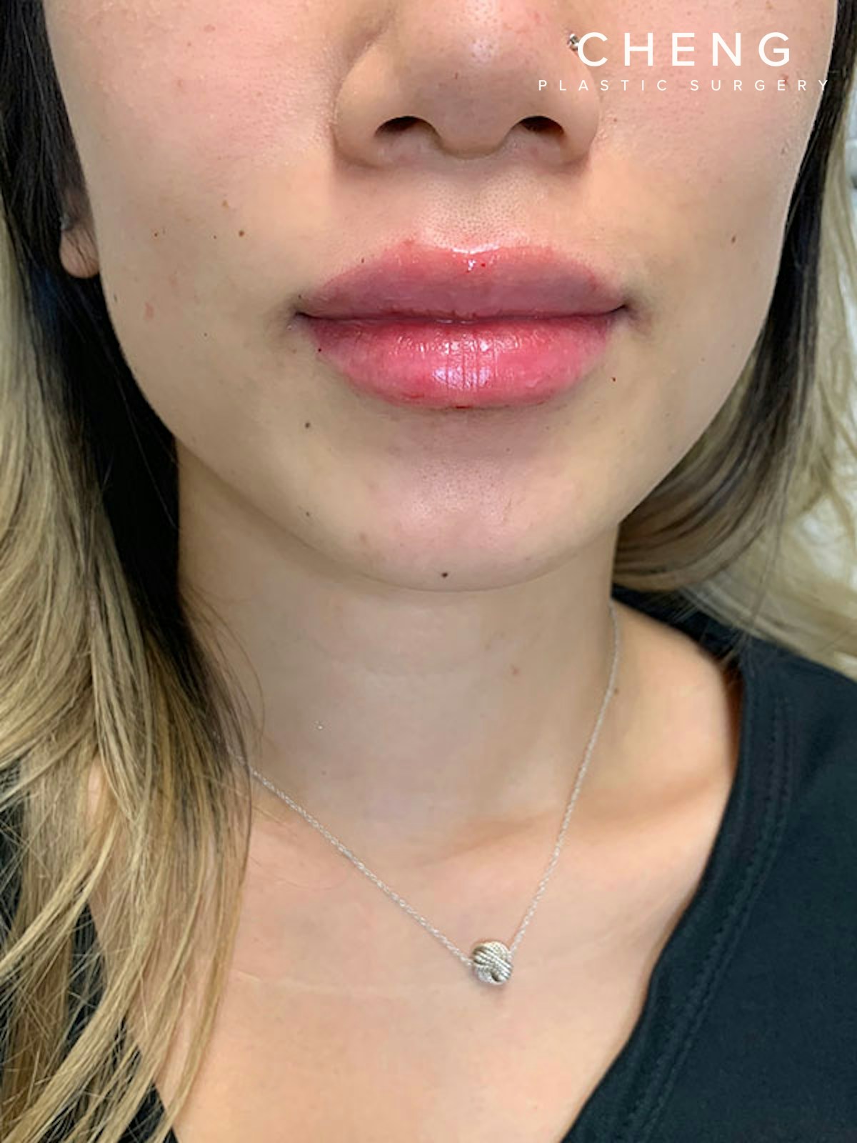 Dermal Fillers Before & After Gallery - Patient 496630 - Image 2