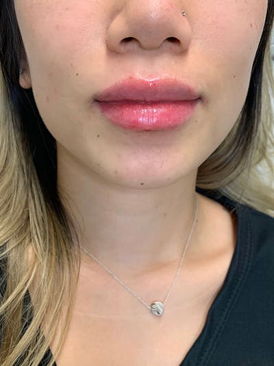 Dermal Fillers Before & After Gallery - Patient 496630 - Image 2