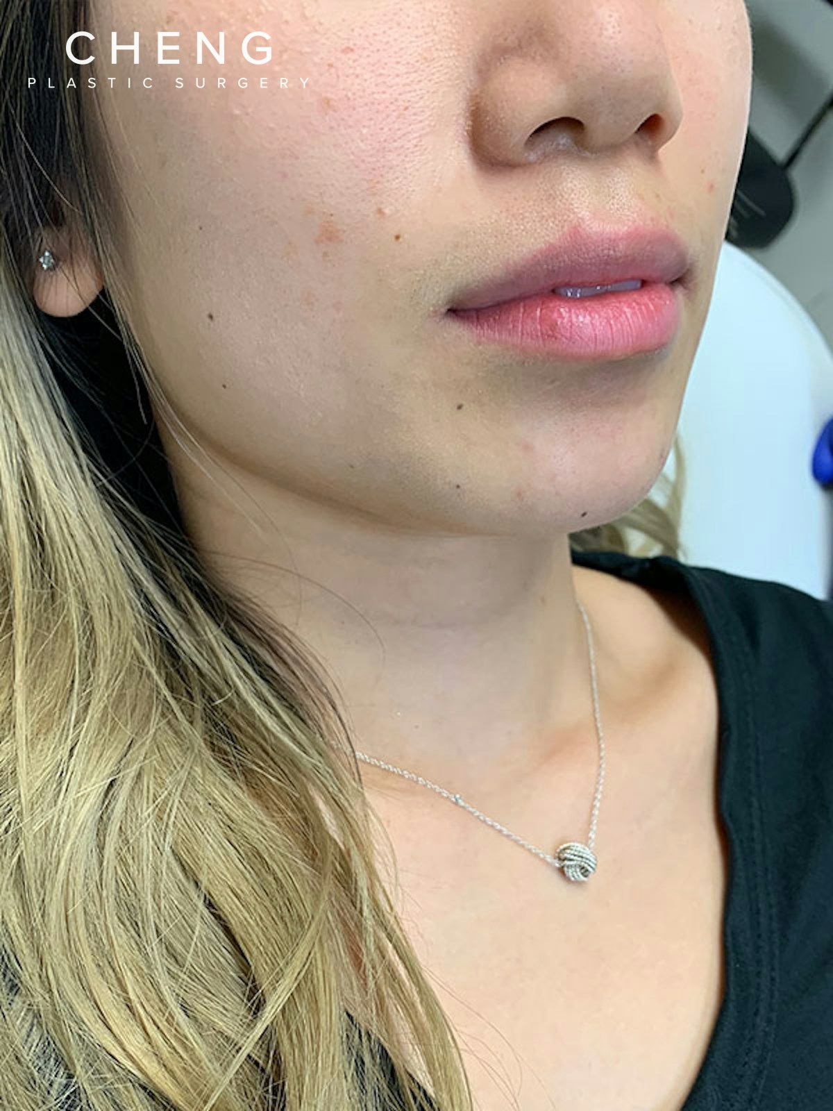 Dermal Fillers Before & After Gallery - Patient 496630 - Image 3
