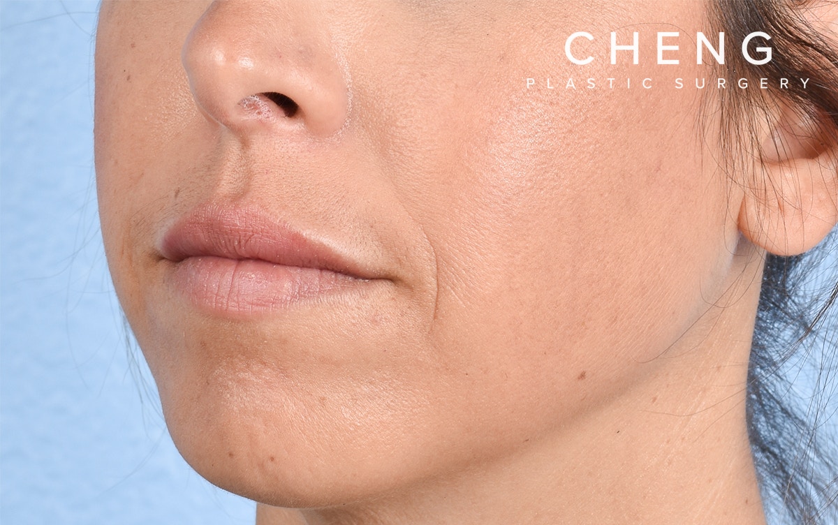 Dermal Fillers Before & After Gallery - Patient 572156 - Image 6