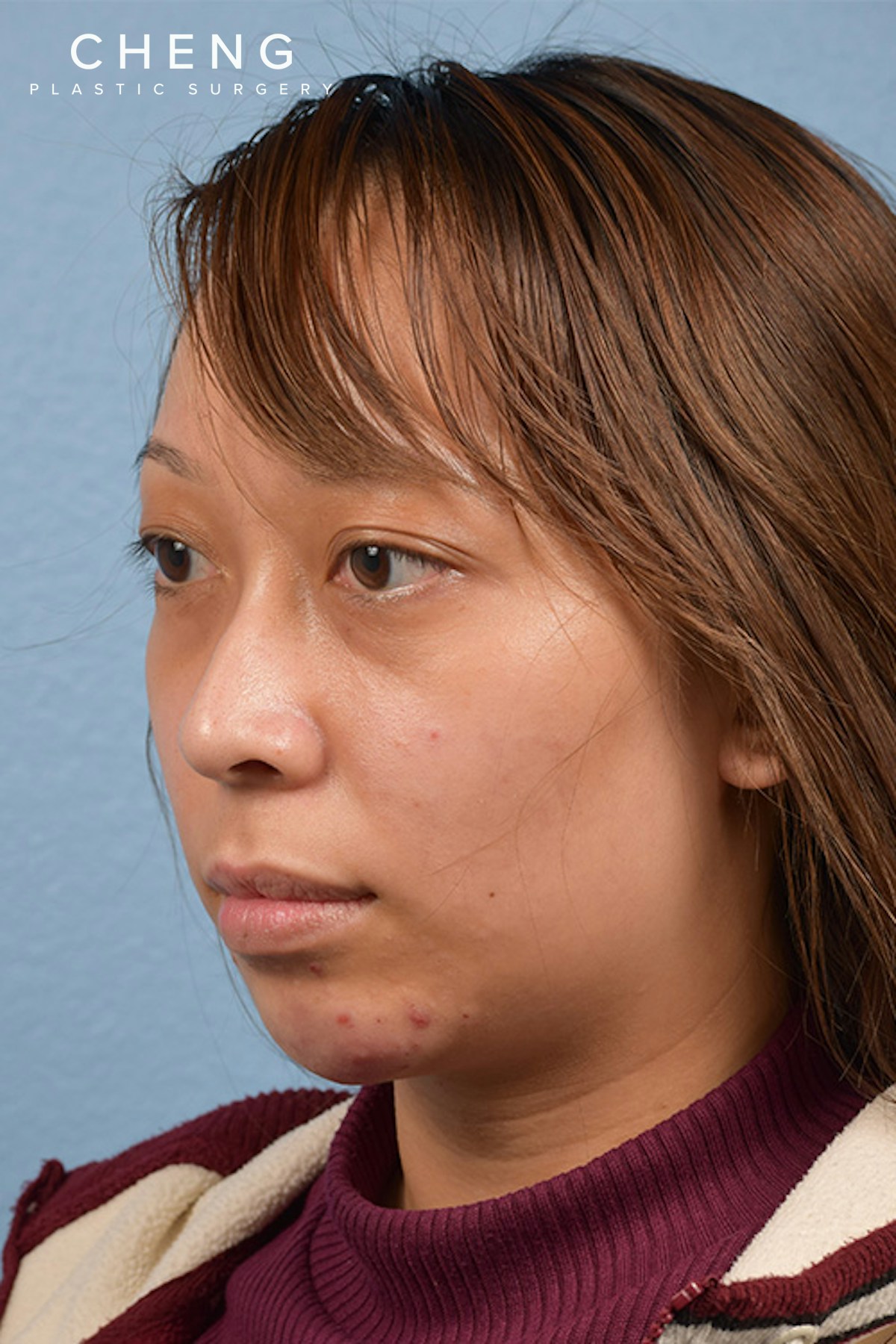 Dermal Fillers Before & After Gallery - Patient 959337 - Image 3