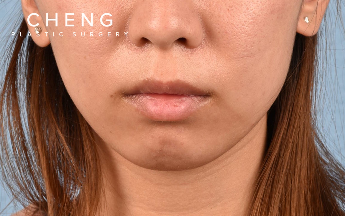 Dermal Fillers Before & After Gallery - Patient 252596 - Image 1