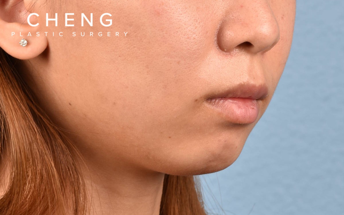 Dermal Fillers Before & After Gallery - Patient 252596 - Image 5