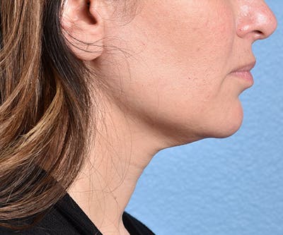 Thermage FLX  Before & After Gallery - Patient 227424 - Image 2
