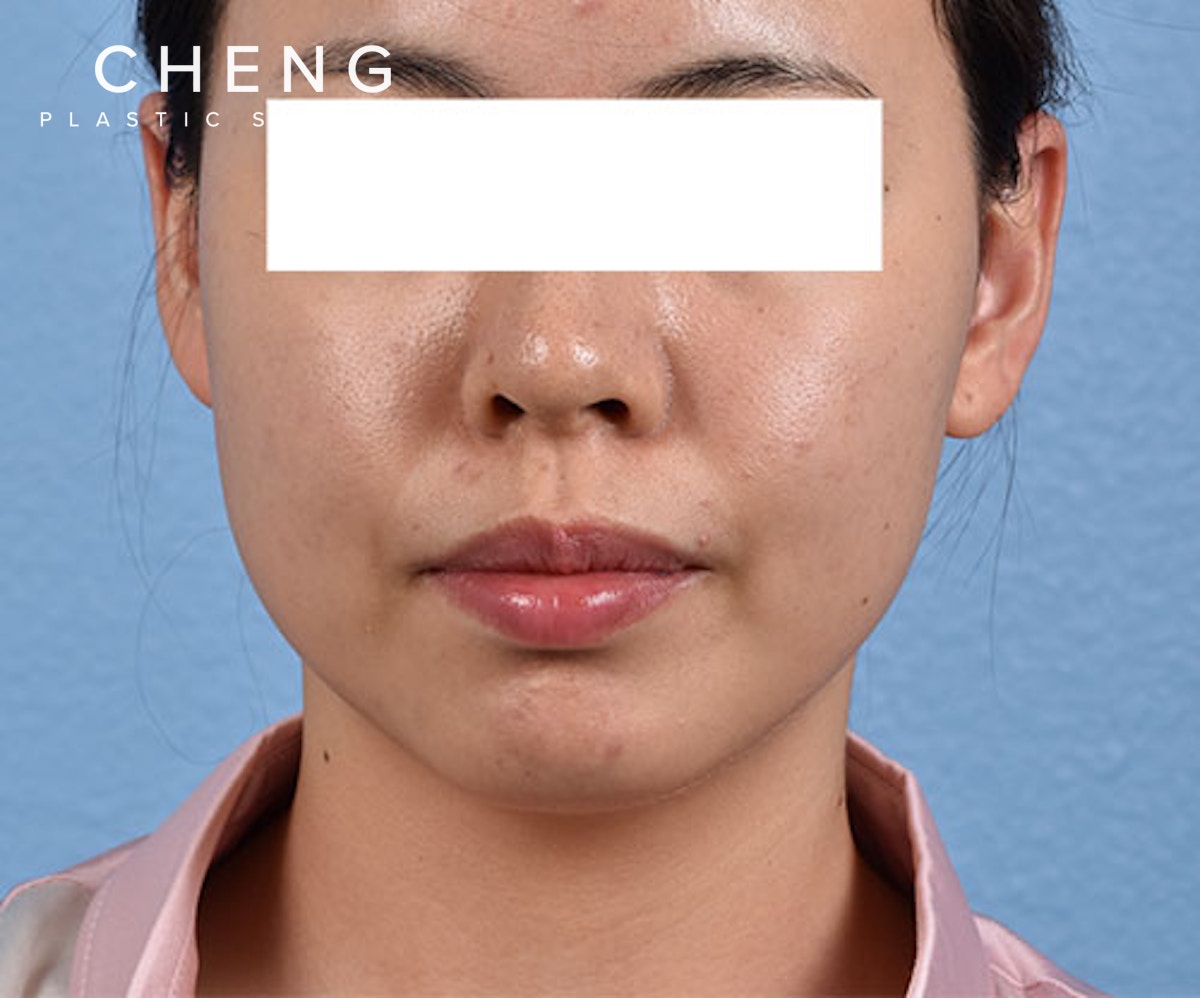 Thermage FLX  Before & After Gallery - Patient 163377 - Image 1