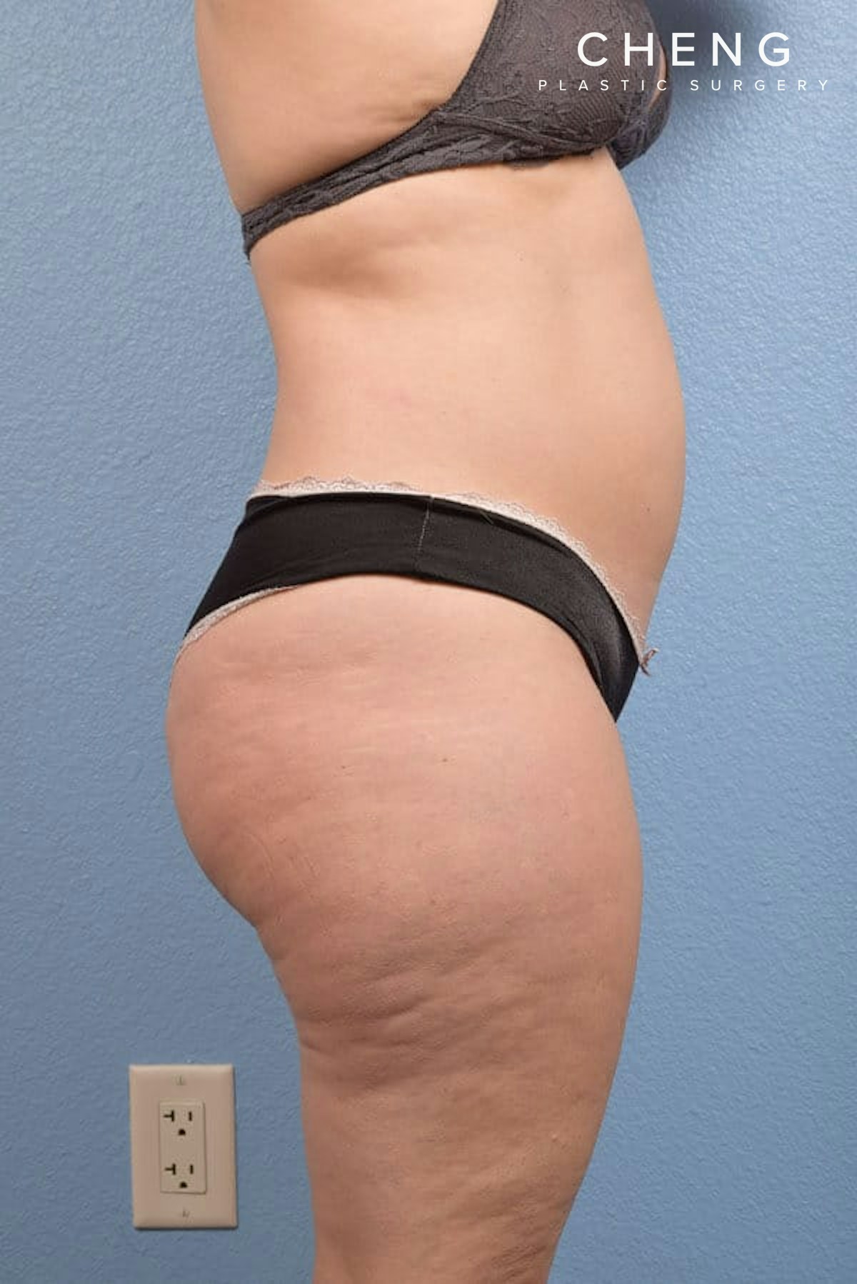 CoolSculpting Before & After Gallery - Patient 168019 - Image 2