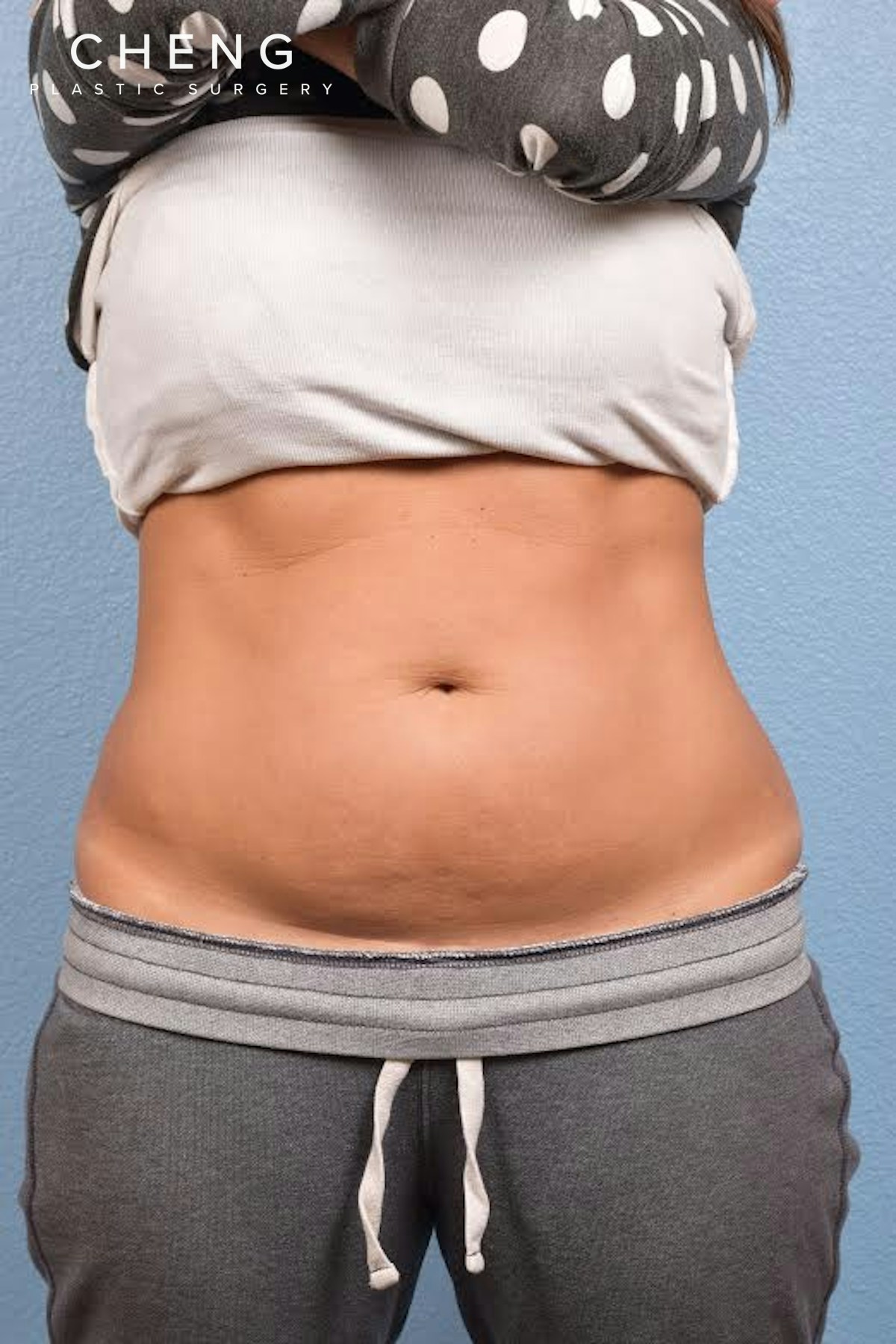 CoolSculpting Before & After Gallery - Patient 156566 - Image 3
