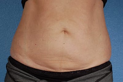 CoolSculpting Before & After Gallery - Patient 290235 - Image 2
