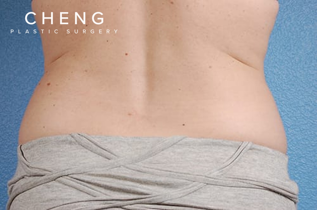 CoolSculpting Before & After Gallery - Patient 184876 - Image 1