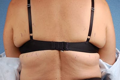 Hidden Patients Before & After Gallery - Patient 100173 - Image 1