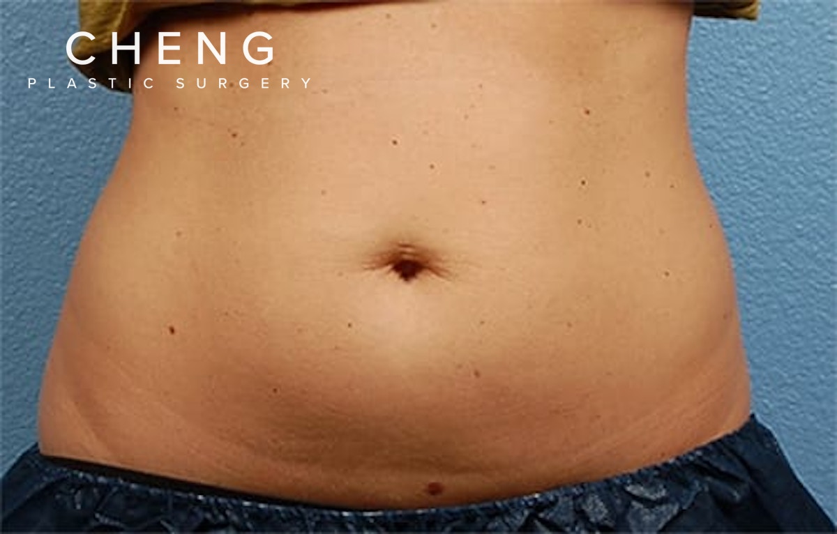 CoolSculpting Before & After Gallery - Patient 126163 - Image 1