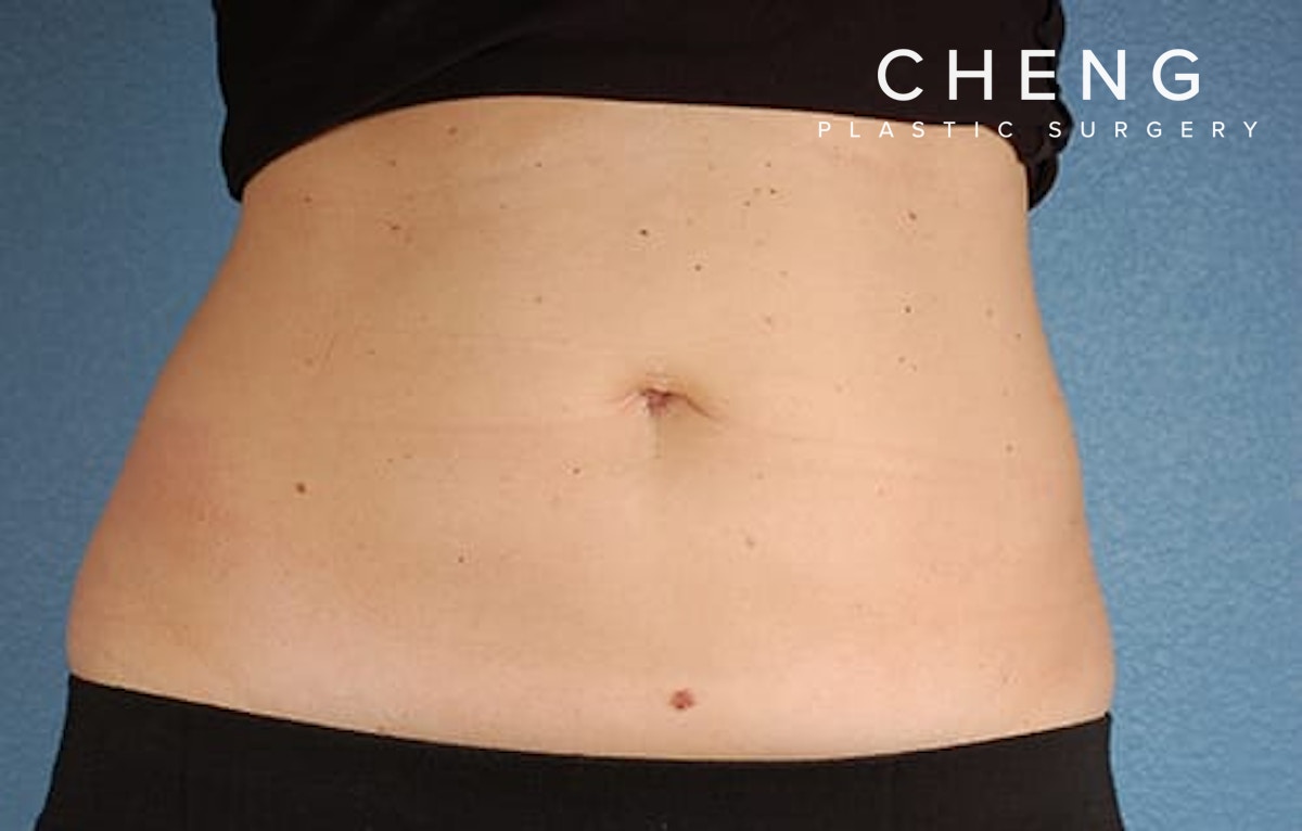CoolSculpting Before & After Gallery - Patient 126163 - Image 2