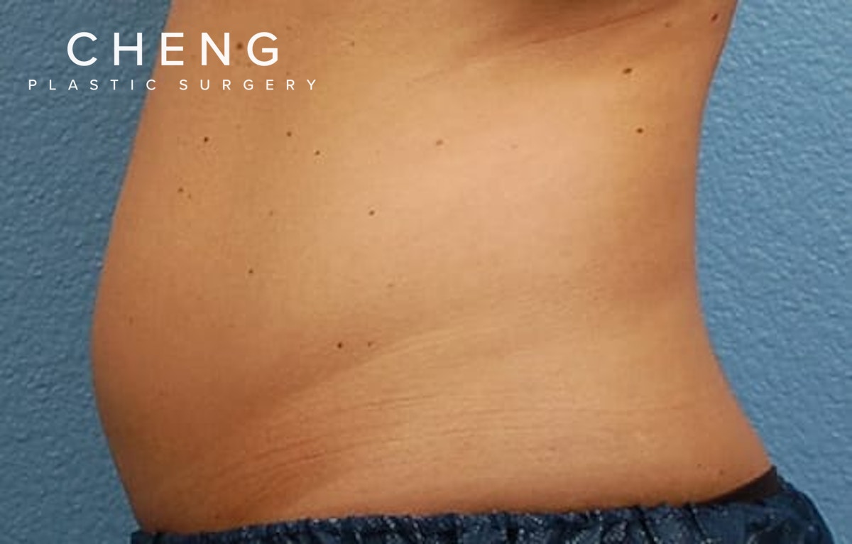CoolSculpting Before & After Gallery - Patient 126163 - Image 3