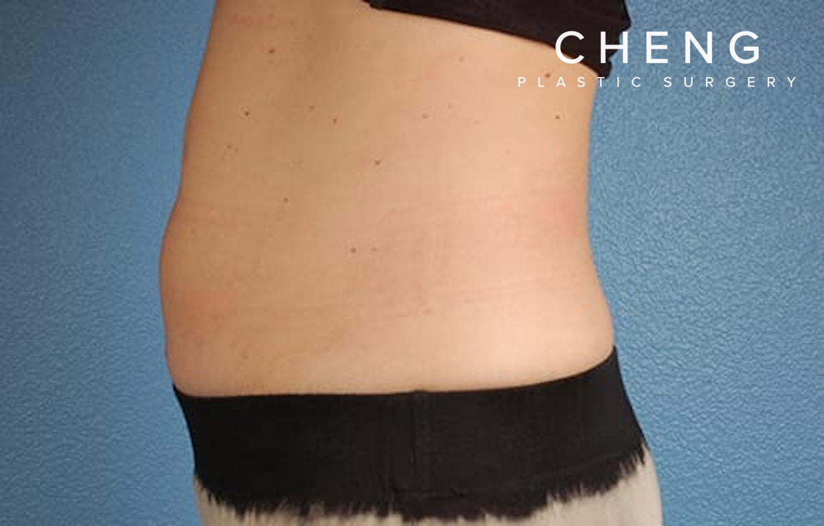 CoolSculpting Before & After Gallery - Patient 126163 - Image 4