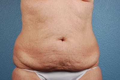 Hidden Patients Before & After Gallery - Patient 107940 - Image 1