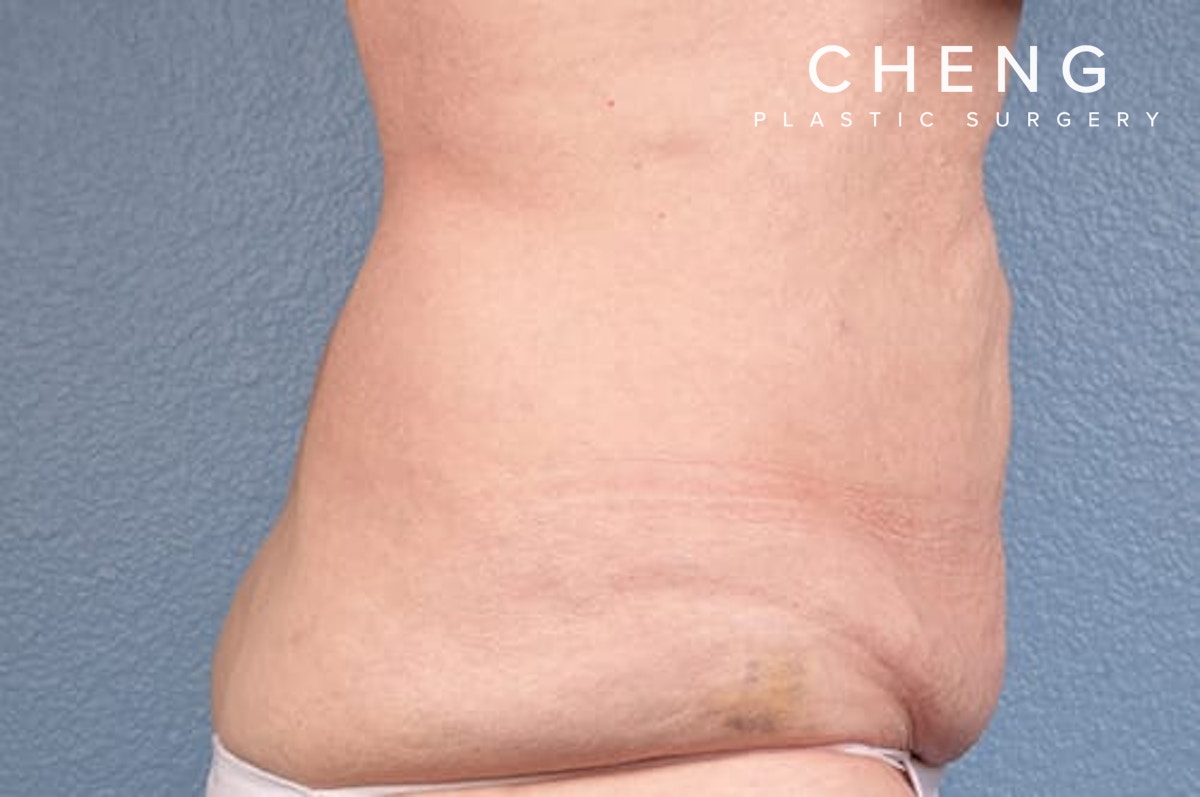 Hidden Patients Before & After Gallery - Patient 107940 - Image 4