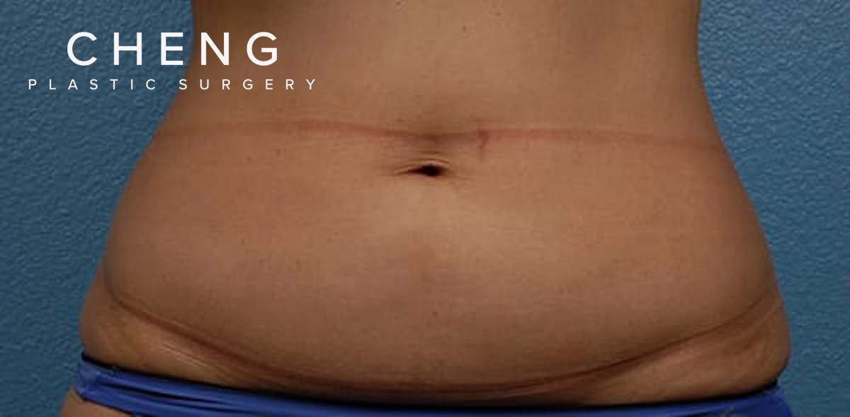 Hidden Patients Before & After Gallery - Patient 331001 - Image 1