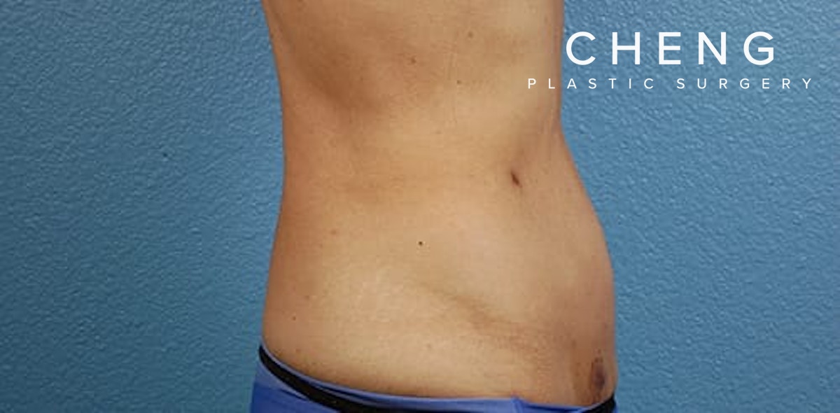 Hidden Patients Before & After Gallery - Patient 331001 - Image 6