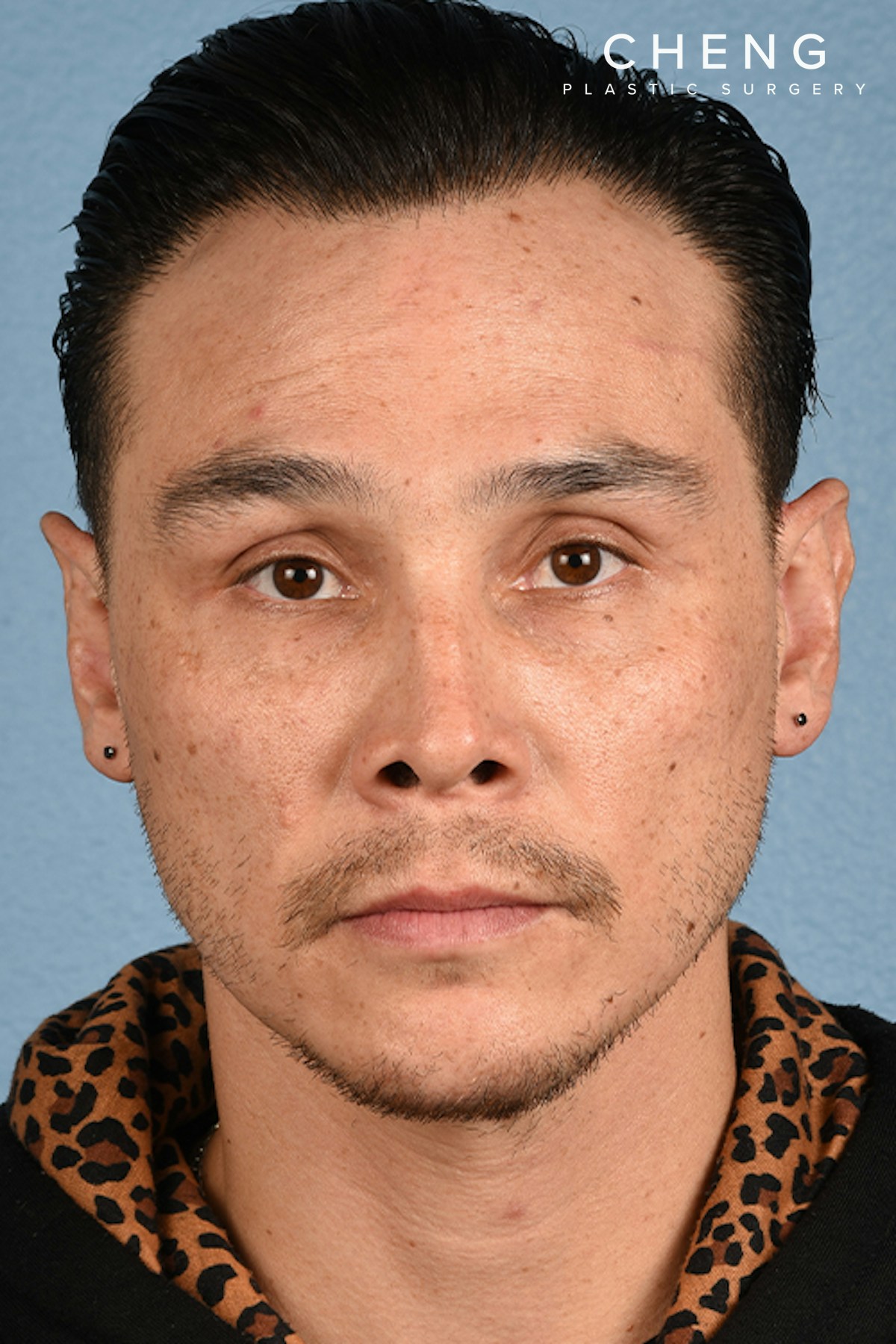 Hidden Patients Before & After Gallery - Patient 381194 - Image 4