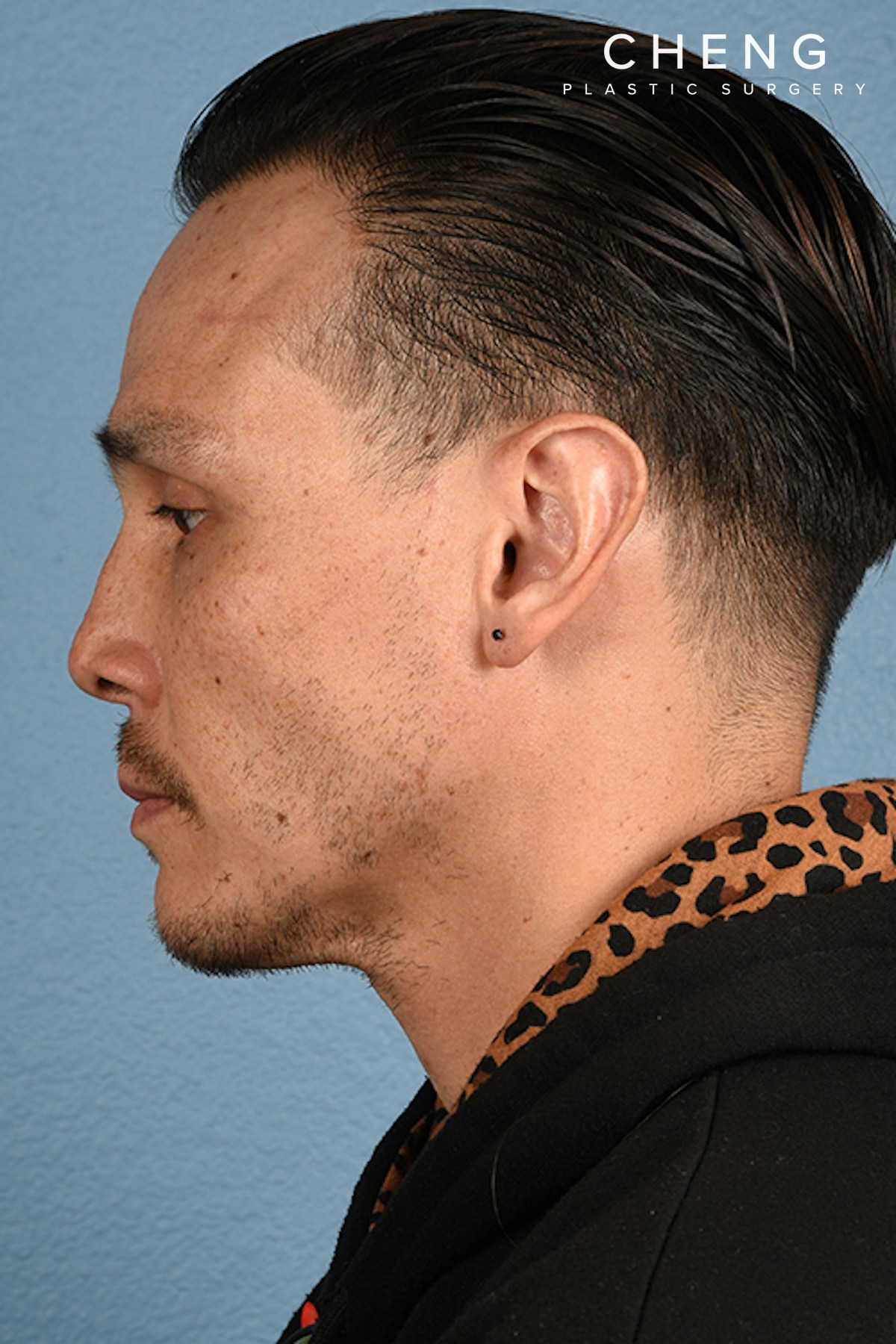 Hidden Patients Before & After Gallery - Patient 381194 - Image 6