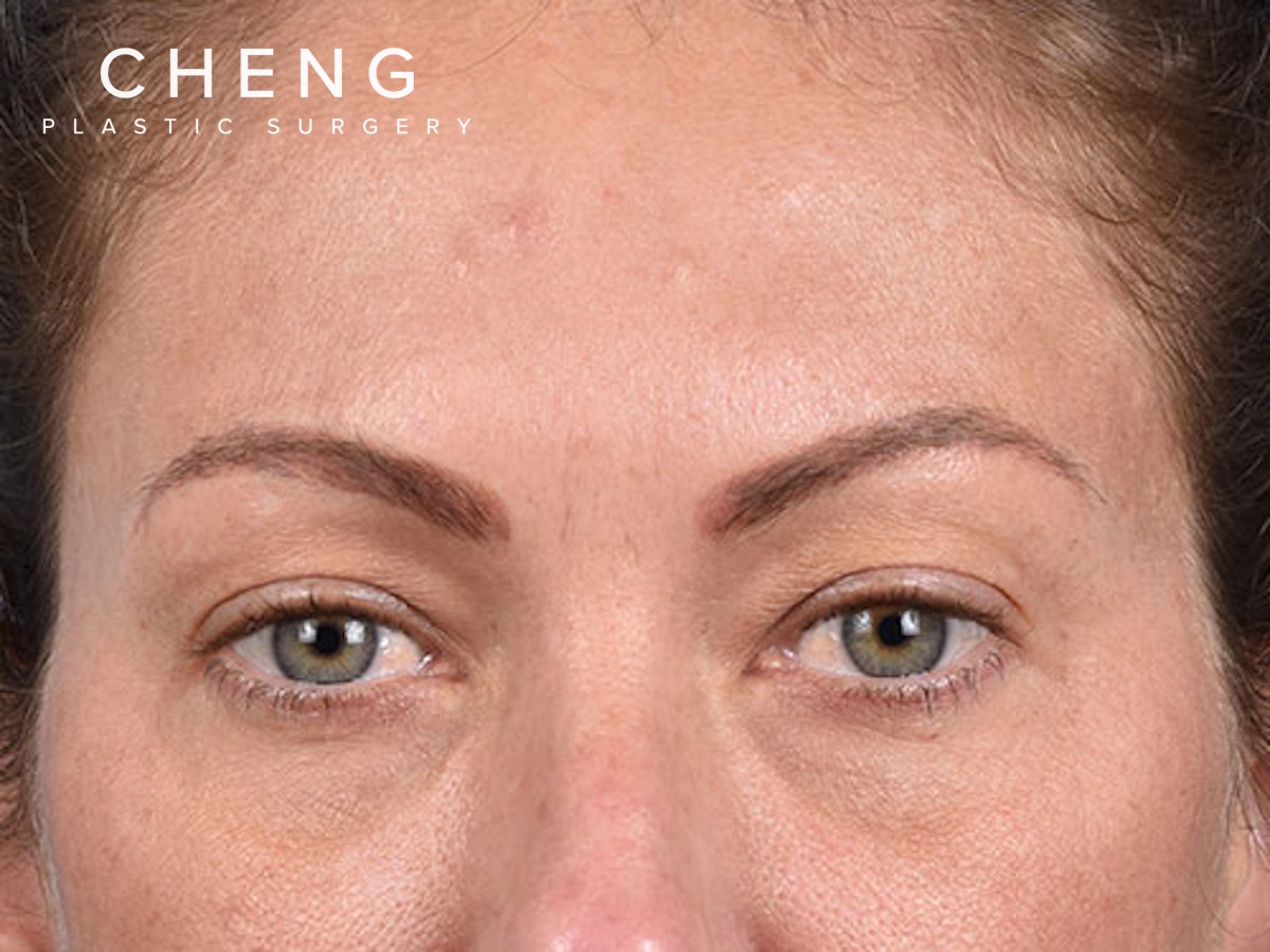Blepharoplasty Before & After Gallery - Patient 213842 - Image 1