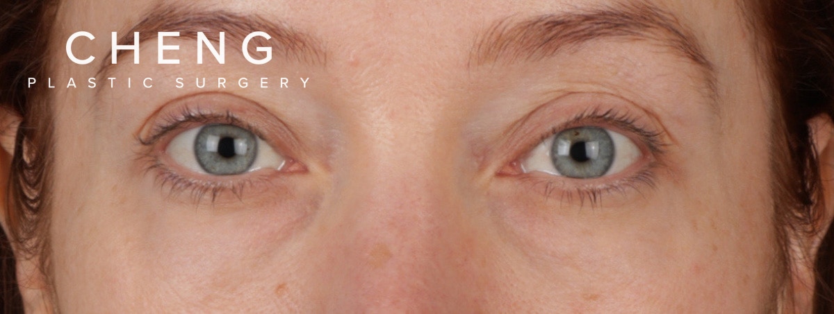Blepharoplasty Before & After Gallery - Patient 310704 - Image 1