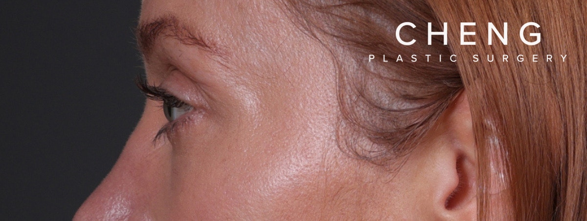 Blepharoplasty Before & After Gallery - Patient 310704 - Image 12