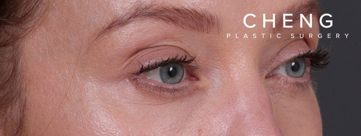 Blepharoplasty Before & After Gallery - Patient 310704 - Image 6