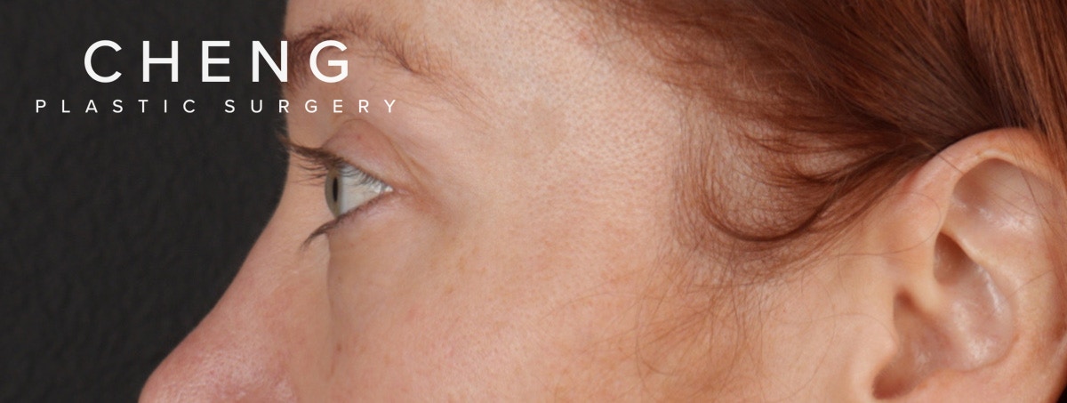 Blepharoplasty Before & After Gallery - Patient 310704 - Image 11