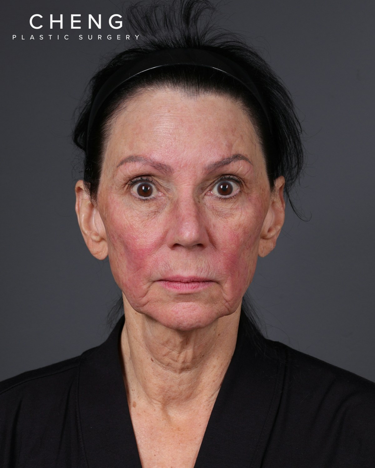 Neck Lift Before & After Gallery - Patient 255571 - Image 9