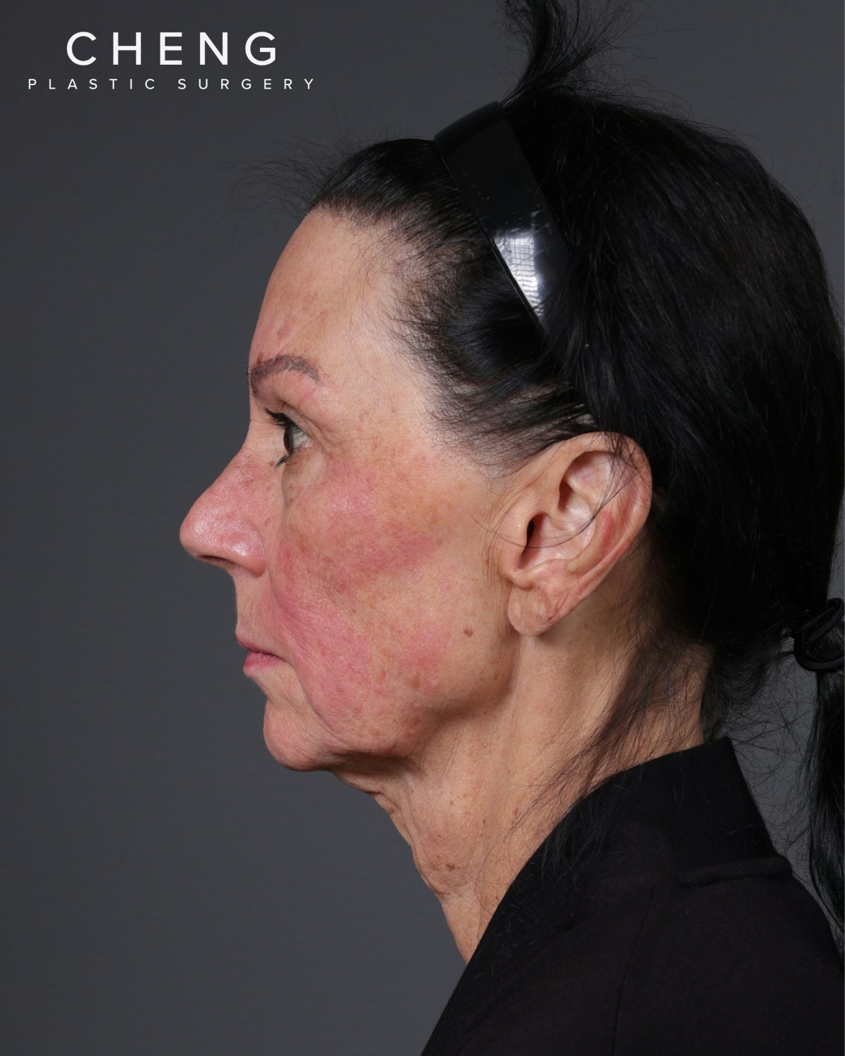 Neck Lift Before & After Gallery - Patient 255571 - Image 17