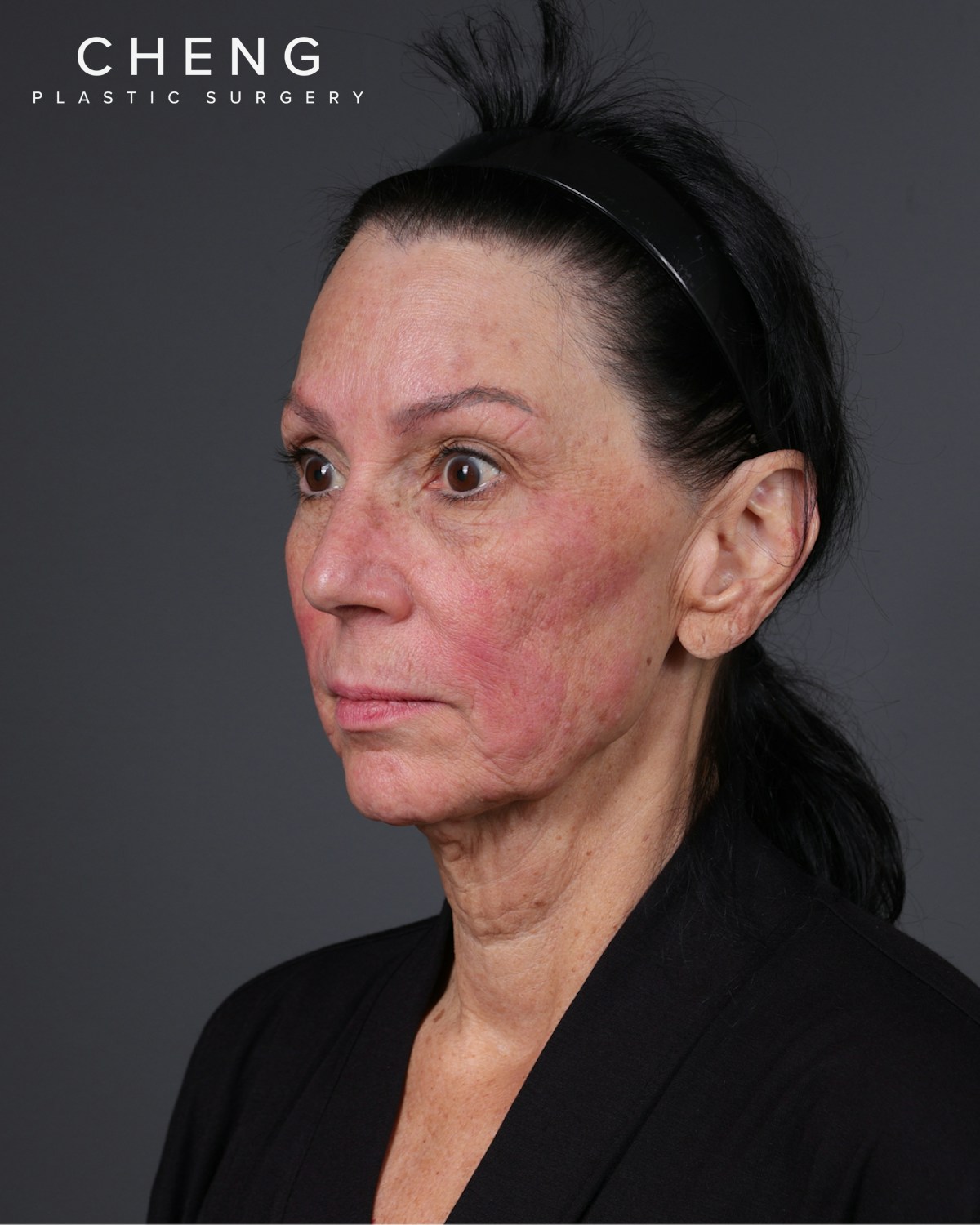 Neck Lift Before & After Gallery - Patient 255571 - Image 15