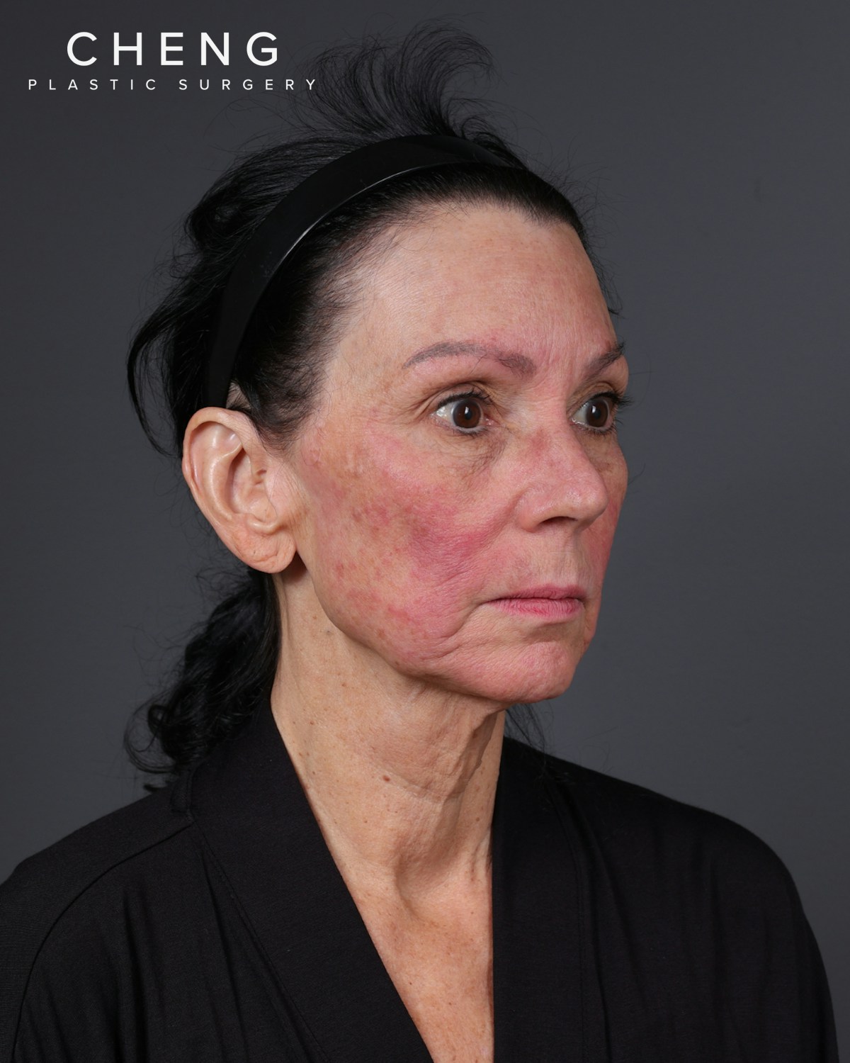 Neck Lift Before & After Gallery - Patient 255571 - Image 11