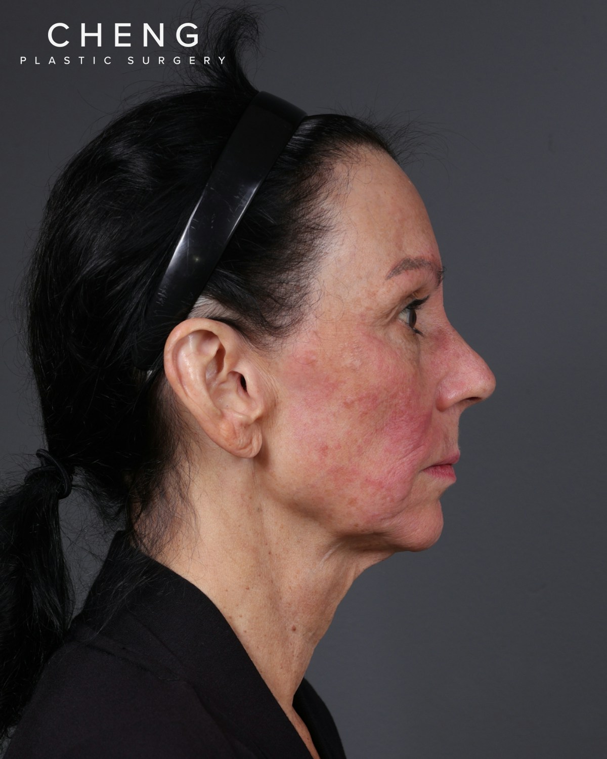 Neck Lift Before & After Gallery - Patient 255571 - Image 13