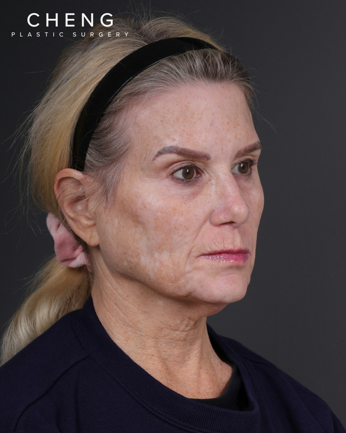 Facelift Before & After Gallery - Patient 105916 - Image 3