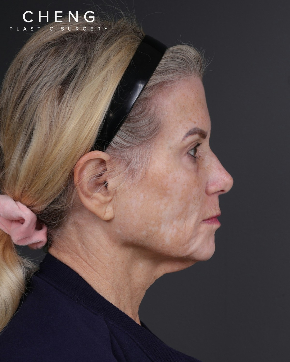 Facelift Before & After Gallery - Patient 105916 - Image 5