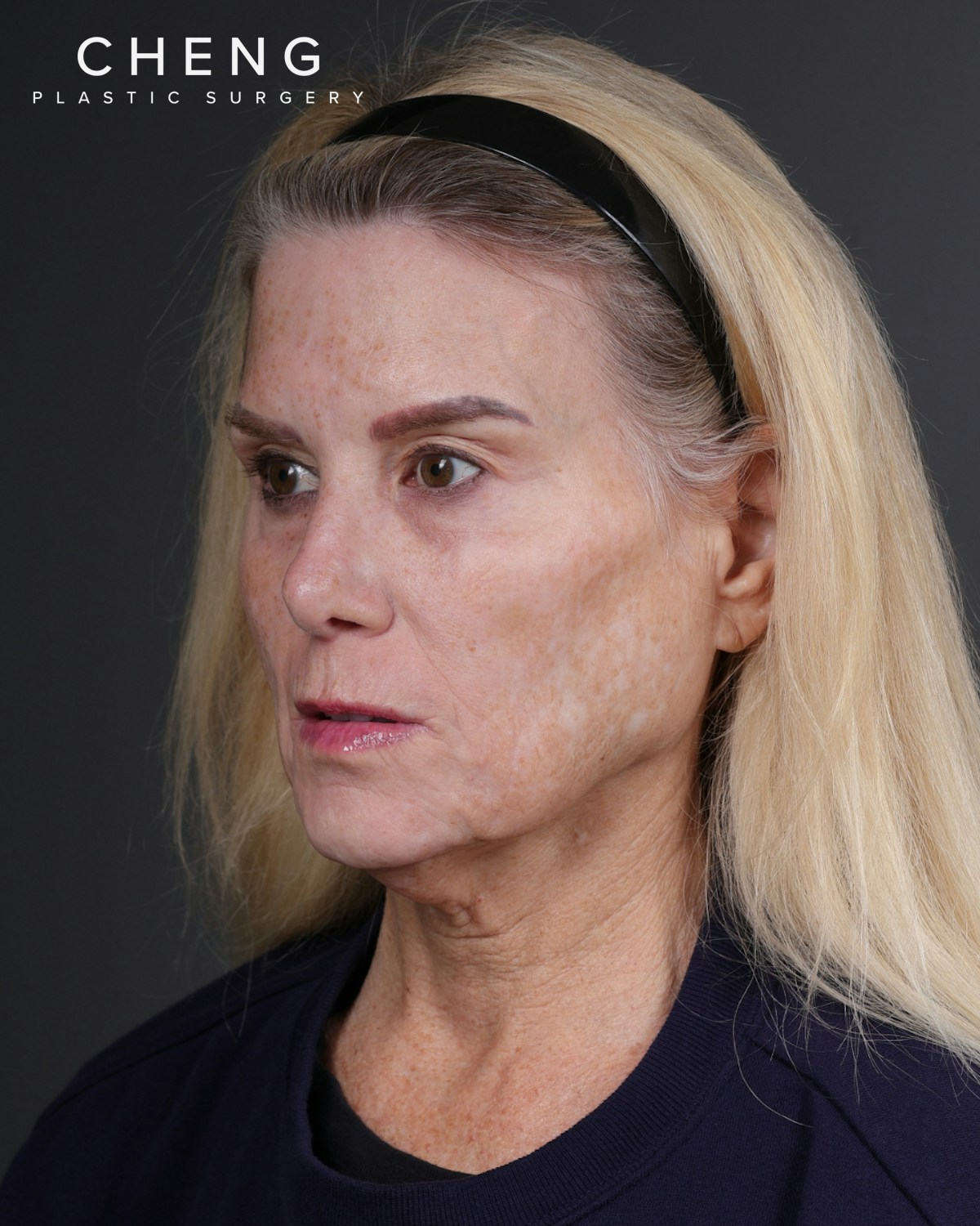 Facelift Before & After Gallery - Patient 105916 - Image 7