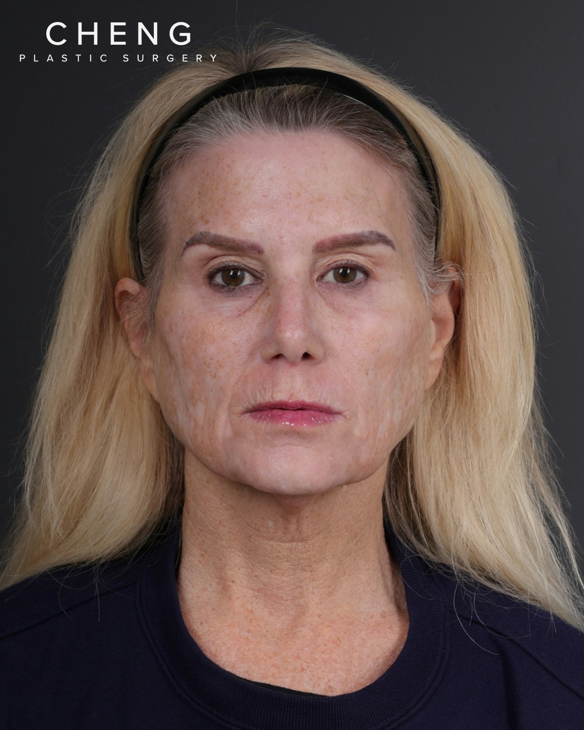 Facelift Before & After Gallery - Patient 105916 - Image 1