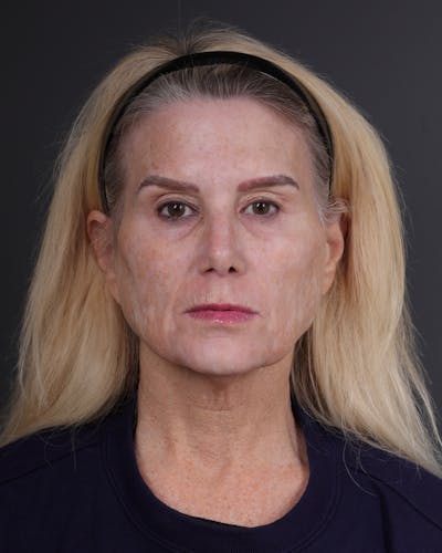 Co2 Laser Before & After Gallery - Patient 294526 - Image 1