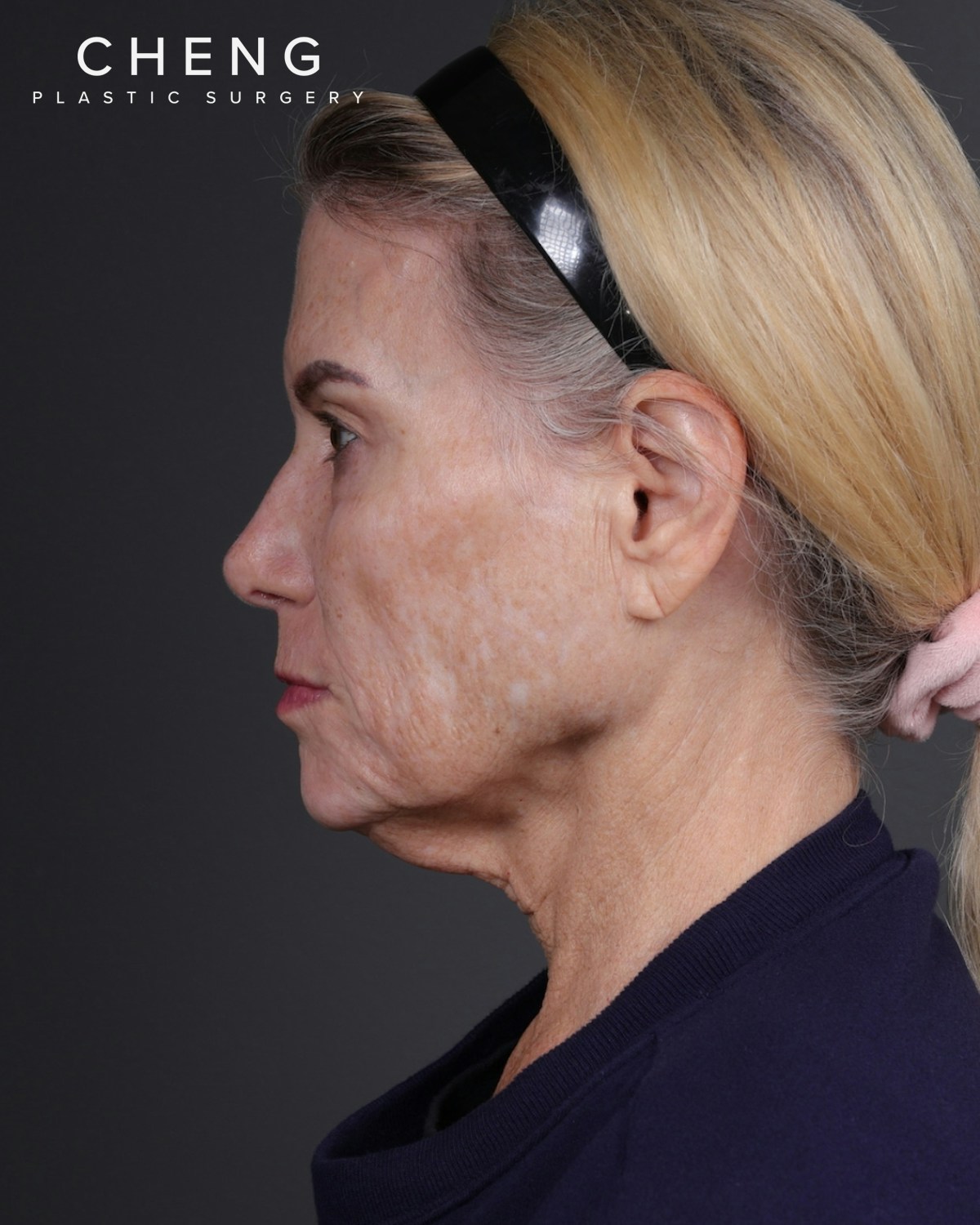 Facelift Before & After Gallery - Patient 105916 - Image 9
