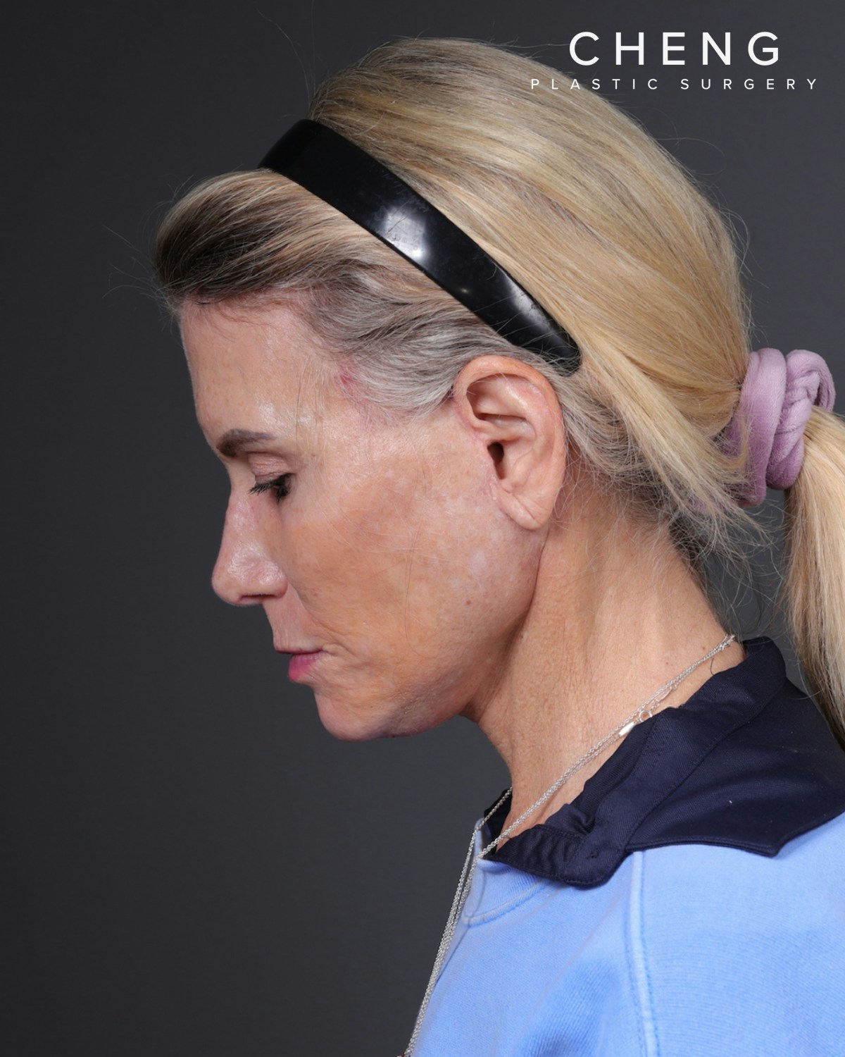 Neck Lift Before & After Gallery - Patient 301904 - Image 12