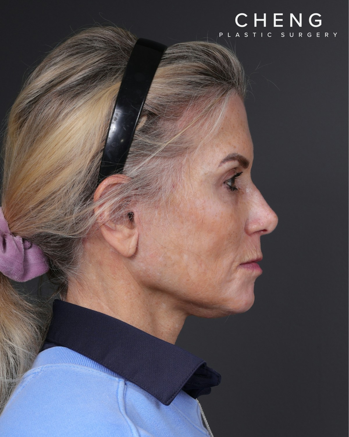 Neck Lift Before & After Gallery - Patient 301904 - Image 6