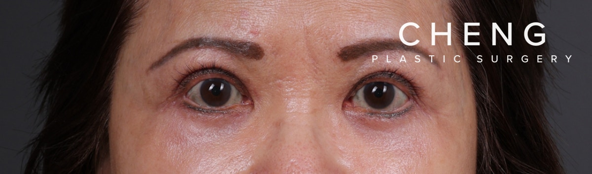 Blepharoplasty Before & After Gallery - Patient 203277 - Image 2