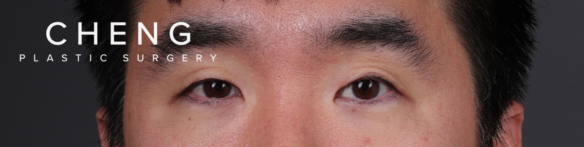 Blepharoplasty Before & After Gallery - Patient 239794 - Image 1