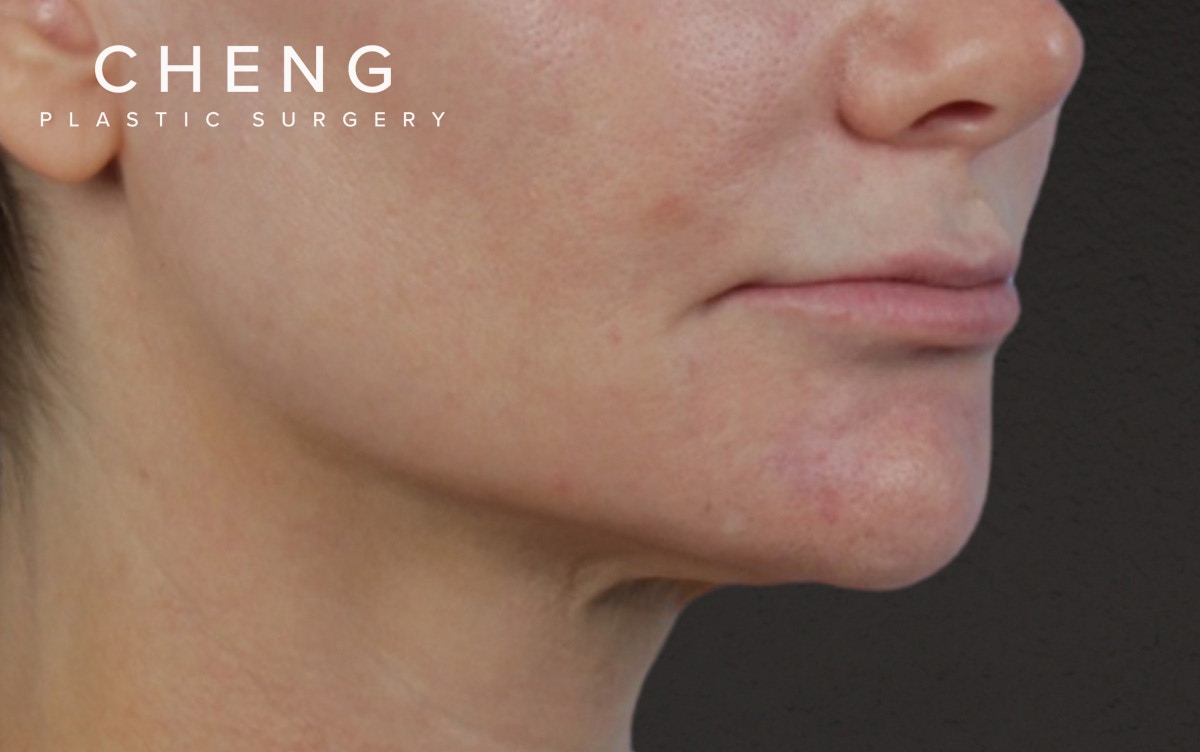 Lip Lift Before & After Gallery - Patient 354154 - Image 3