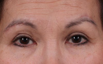 Blepharoplasty Before & After Gallery - Patient 212534 - Image 2