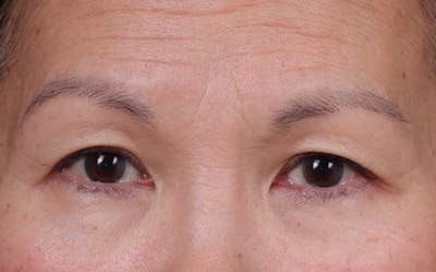Blepharoplasty Before & After Gallery - Patient 212534 - Image 1