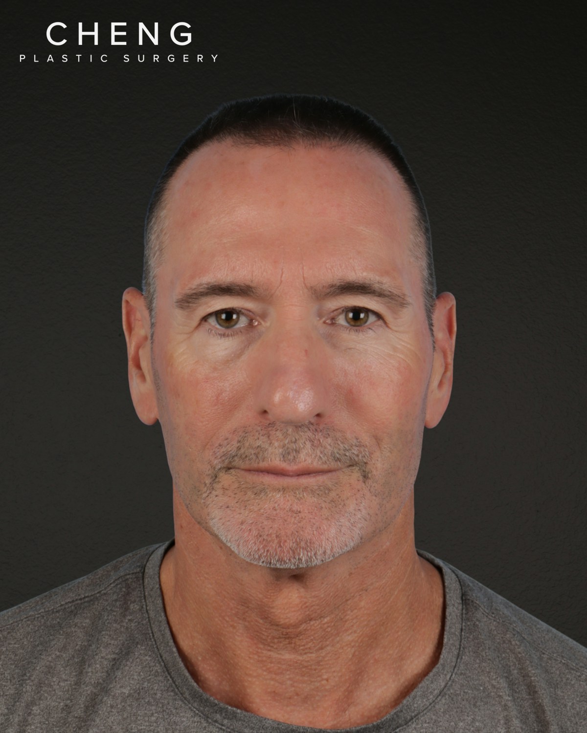 Rhinoplasty Before & After Gallery - Patient 115093 - Image 3