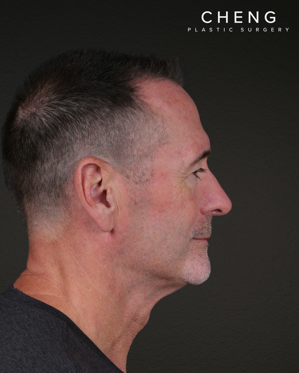 Rhinoplasty Before & After Gallery - Patient 115093 - Image 2