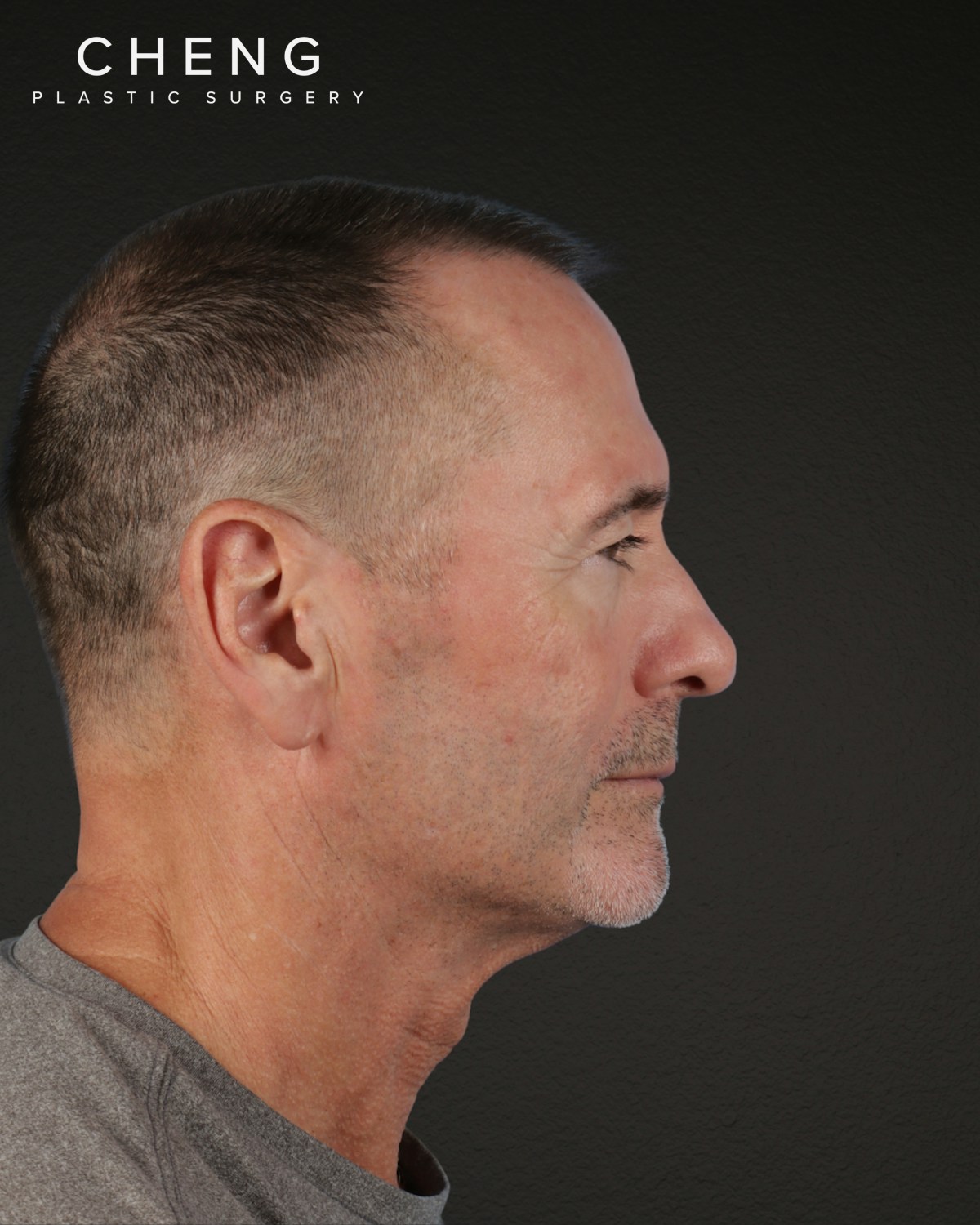 Rhinoplasty Before & After Gallery - Patient 115093 - Image 1